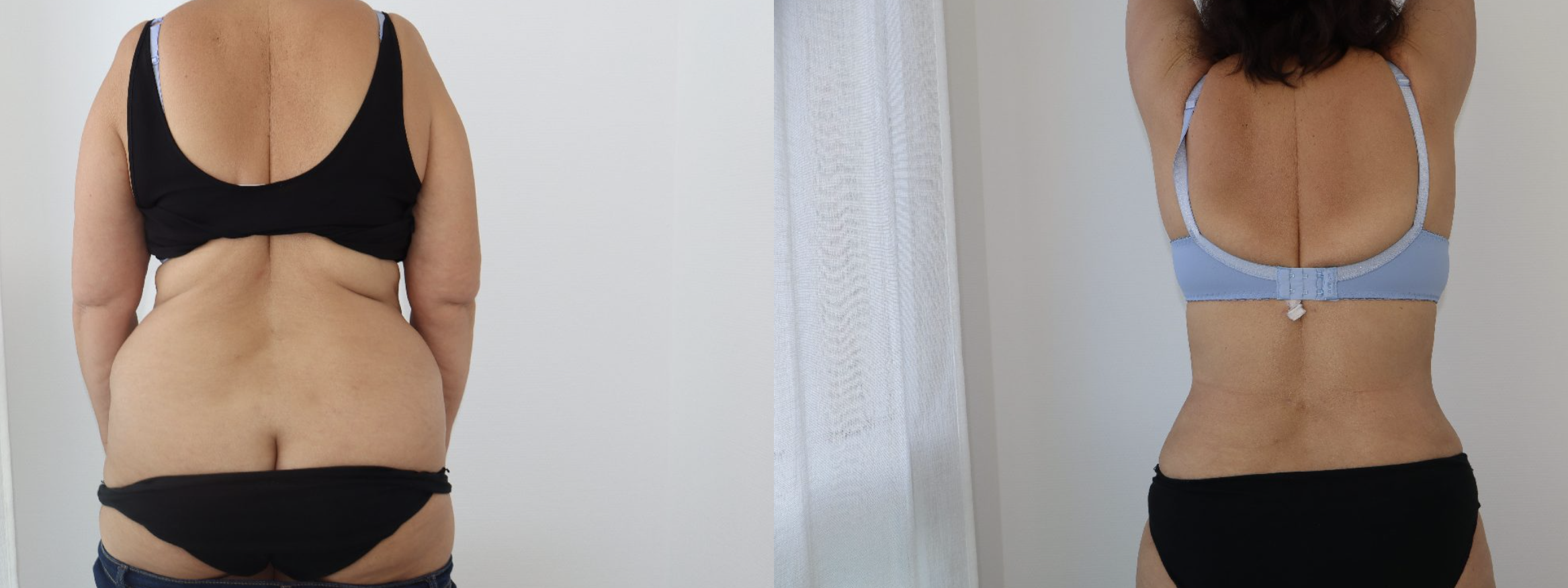 Avant/Après lipoaspiration flancs abdomen